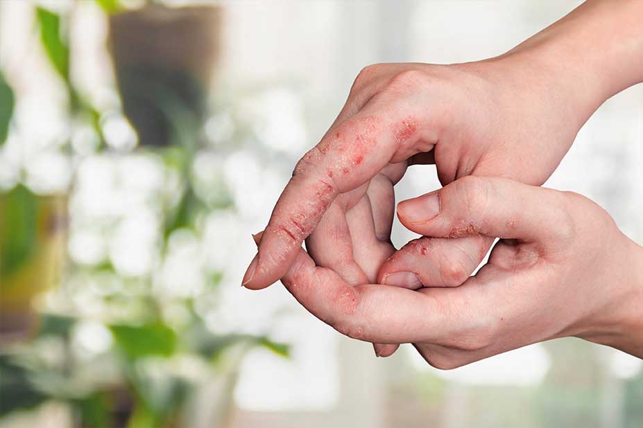 Ragadi mani non sottovalutiamole: cause, prevenzione e cure